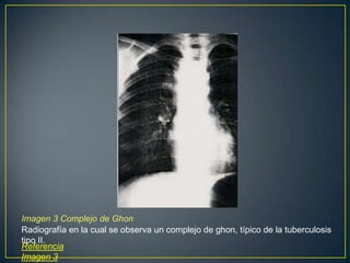 Imagen 3 Complejo de Ghon
Radiografía en la cual se observa un complejo de ghon, típico de la tuberculosis
tipo II.
Referencia
Imagen 3
 