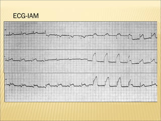 ECG-IAM 
