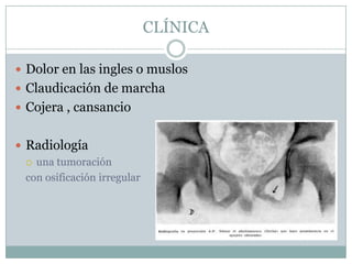 CLÍNICA

 Dolor en las ingles o muslos
 Claudicación de marcha
 Cojera , cansancio


 Radiología
   una tumoración

  con osificación irregular
 
