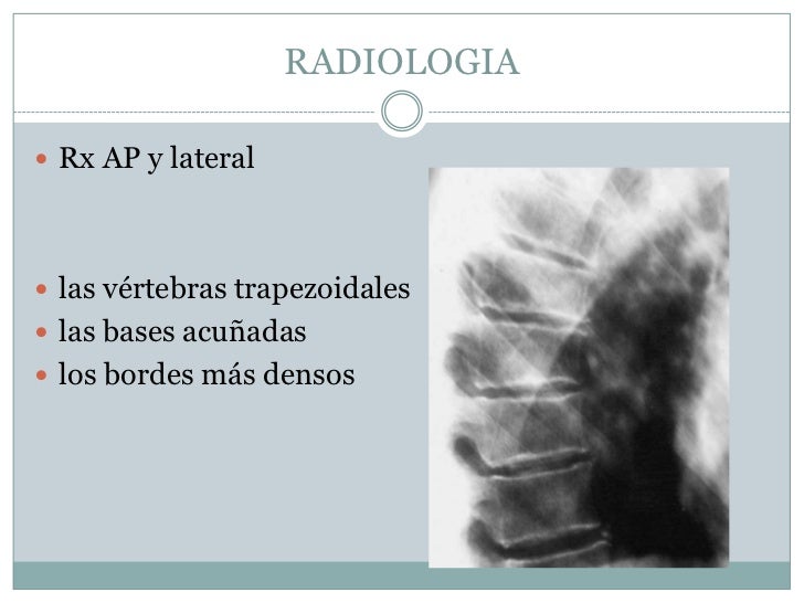 Si es posible dar a luz a la osteocondrosis del departamento lumbar