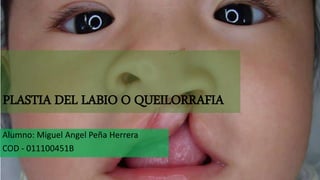 PLASTIA DEL LABIO O QUEILORRAFIA
Alumno: Miguel Angel Peña Herrera
COD - 011100451B
 
