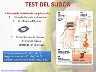  Método de iontoforesis con pilocarpina
        1. Estimulación de la sudoración
           2. Recolección del sudor




                1.      Determinación de cloruro
                             Titrimetría clásica
                          Electrodo ión-selectivo


     Positivo: valores > 60 mEq/L de Cl
     Negativo: valores < 60 mEq/L de Cl
     Dudoso: valores entre 50-60 mEq/L de Cl



http://alucinamedicina.com/tag/eco-fibrosis/
 