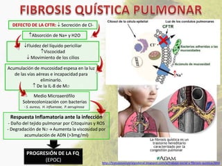 DEFECTO DE LA CFTR:            Secreción de Cl-

             Absorción de Na+ y H2O

         Fluidez del líquido periciliar
                  Viscocidad
           Movimiento de los cilios

Acumulación de mucosidad espesa en la luz
   de las vías aéreas e incapacidad para
                 eliminarlo.
               De la IL-8 de M

            Medio Microaerófilo
       Sobrecolonización con bacterias
        - S. aureus, H. influenzae, P. aeruginosa

 Respuesta Inflamatoria ante la infección
 - Daño del tejido pulmonar por Citoquinas y ROS
- Degradación de N  Aumenta la viscosidad por
         acumulación de ADN (>3mg/ml)


         PROGRESIÓN DE LA FQ
               (EPOC)                               http://trabajosocialelalgodonal.blogspot.com/p/trabajo-social-y-fibrosis-quistica.html
 