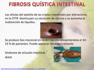 Las células del epitelio de las criptas intestinales por alteraciones
      en la CFTR disminuyen su secreción de cloruro y se aumenta la
      reabsorción de líquidos.




      Se produce íleo meconial en recién nacidos presentándola el 10-
      15 % de pacientes. Puede aparecer intrauterinamente

      Síndrome de oclusión intestinal
      distal


http://www.pedsurg.com.pe/Obstruccion_intestinal_por_ileo_meconial.php
 
