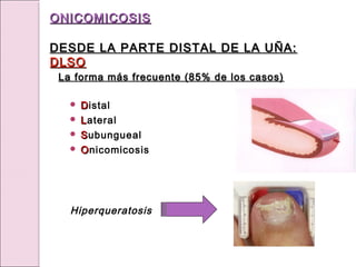  D
Distal
 L
Lateral
 S
Subungueal
 O
Onicomicosis
Hiperqueratosis
ONICOMICOSIS
ONICOMICOSIS
DESDE LA PARTE DISTAL DE LA UÑA:
DESDE LA PARTE DISTAL DE LA UÑA:
DLSO
DLSO
La forma más frecuente (85% de los casos)
La forma más frecuente (85% de los casos)
 