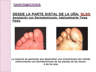 La mayoría de pacientes que desarrollan una onicomicosis han sufrido
anteriormente una dermatomicosis de las plantas de las manos
ó de los pies
ONICOMICOSIS
ONICOMICOSIS
DESDE LA PARTE DISTAL DE LA UÑA:
DESDE LA PARTE DISTAL DE LA UÑA: DLSO
DLSO
Asociación con Dermatomicosis, habitualmente Tinea
Asociación con Dermatomicosis, habitualmente Tinea
Pedis
Pedis
 