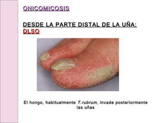 El hongo, habitualmente T.rubrum, invade posteriormente
las uñas
ONICOMICOSIS
ONICOMICOSIS
DESDE LA PARTE DISTAL DE LA UÑA:
DESDE LA PARTE DISTAL DE LA UÑA:
DLSO
DLSO
 