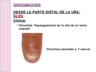  Onicolisis: Despegamiento de la uña de su lecho
ungueal
Onicolisis asociada a T.rubrum
ONICOMICOSIS
ONICOMICOSIS
DESDE LA PARTE DISTAL DE LA UÑA:
DESDE LA PARTE DISTAL DE LA UÑA:
DLSO
DLSO
Clínica
Clínica:
:
 