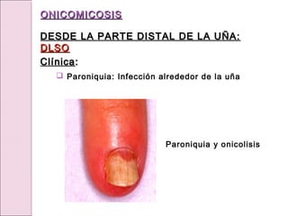 Paroniquia y onicolisis
ONICOMICOSIS
ONICOMICOSIS
DESDE LA PARTE DISTAL DE LA UÑA:
DESDE LA PARTE DISTAL DE LA UÑA:
DLSO
DLSO
Clínica
Clínica:
:
 Paroniquia: Infección alrededor de la uña
 
