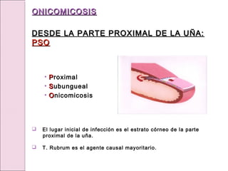 • P
Proximal
• S
Subungueal
• O
Onicomicosis
 El lugar inicial de infección es el estrato córneo de la parte
proximal de la uña.
 T. Rubrum es el agente causal mayoritario.
DESDE LA PARTE PROXIMAL DE LA UÑA:
DESDE LA PARTE PROXIMAL DE LA UÑA:
PSO
PSO
ONICOMICOSIS
ONICOMICOSIS
 