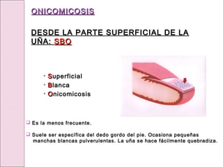  Es la menos frecuente.
 Suele ser específica del dedo gordo del pie. Ocasiona pequeñas
manchas blancas pulverulentas. La uña se hace fácilmente quebradiza.
ONICOMICOSIS
ONICOMICOSIS
DESDE LA PARTE SUPERFICIAL DE LA
DESDE LA PARTE SUPERFICIAL DE LA
UÑA:
UÑA: SBO
SBO
• S
Superficial
• B
Blanca
• O
Onicomicosis
 