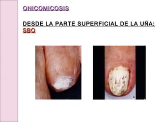 ONICOMICOSIS
ONICOMICOSIS
DESDE LA PARTE SUPERFICIAL DE LA UÑA:
DESDE LA PARTE SUPERFICIAL DE LA UÑA:
SBO
SBO
 