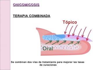 Tópico
Se combinan dos vías de tratamiento para mejorar las tasas
de curaciones
ONICOMICOSIS
ONICOMICOSIS
TERAPIA COMBINADA
TERAPIA COMBINADA
 