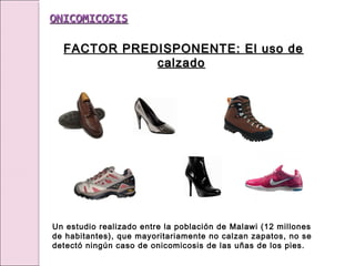 Un estudio realizado entre la población de Malawi (12 millones
de habitantes), que mayoritariamente no calzan zapatos, no se
detectó ningún caso de onicomicosis de las uñas de los pies.
FACTOR PREDISPONENTE: El uso de
FACTOR PREDISPONENTE: El uso de
calzado
calzado
ONICOMICOSIS
ONICOMICOSIS
 
