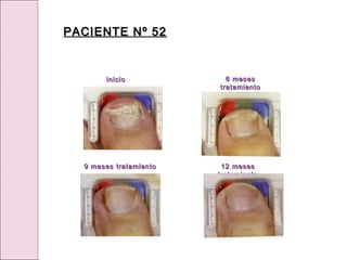 inicio
inicio
12 meses
12 meses
tratamiento
tratamiento
6 meses
6 meses
tratamiento
tratamiento
9 meses tratamiento
9 meses tratamiento
PACIENTE Nº 52
PACIENTE Nº 52
 