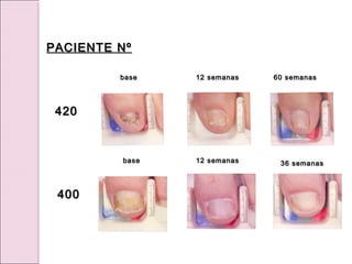 base
base 12 semanas
12 semanas 60 semanas
60 semanas
base
base 12 semanas
12 semanas 36 semanas
36 semanas
PACIENTE Nº
PACIENTE Nº
420
420
400
400
 