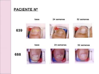 52 semanas
52 semanas
24 semanas
24 semanas
base
base
base
base
24 semanas
24 semanas 52 semanas
52 semanas
PACIENTE Nº
PACIENTE Nº
639
639
688
688
 