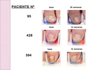 36 semanas
36 semanas
base
base
base
base
12 semanas
12 semanas
base
base 12 semanas
12 semanas
PACIENTE Nº
PACIENTE Nº
95
95
428
428
394
394
 