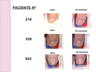 48 semanas
48 semanas
base
base
base
base
60 semanas
60 semanas
base
base 36 semanas
36 semanas
218
218
339
339
622
622
PACIENTE Nº
PACIENTE Nº
 