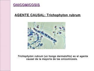 Trichophyton rubrum (un hongo dermatofito) es el agente
causal de la mayoría de las onicomicosis.
AGENTE CAUSAL: Trichophyton rubrum
AGENTE CAUSAL: Trichophyton rubrum
ONICOMICOSIS
ONICOMICOSIS
 