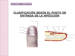 ONICOMICOSIS
ONICOMICOSIS
CLASIFICACIÓN SEGÚN EL PUNTO DE
CLASIFICACIÓN SEGÚN EL PUNTO DE
ENTRADA DE LA INFECCIÓN
ENTRADA DE LA INFECCIÓN
 