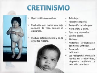 •   Hipertiroidismo en niños.      •   Talla baja.
                                   •   Facciones ásperas.
•   Producido por madre con bajo •     Protrusión de la lengua.
    consumo de yodo durante el •       Nariz ancha y plana.
    embarazo.
                                   •   Ojos muy separados.
                                   •   Cabello escaso.
•   Produce retardo mental y en la
                                   •   Piel seca.
    actividad motora.
                                   •   Abdomen protuberante
                                       con hernia umbilical.
                                  •    Desarrollo          mental
                                       deficiente.
                                  •    Las radiografías muestran
                                       retraso en la edad ósea,
                                       disgenesia epifisiaria y
                                       dentición retardada.
 