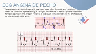 ECG ANGINA DE PECHO
Generalmente se correlaciona con una oclusión incompleta de una arteria coronaria
Puede ser transitori...