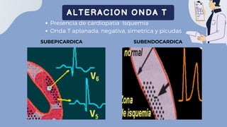 Presencia de lesion celular
ALTERACION SEG ST
Convexo en lomo de delfin
Elevado o descendido mas de 1mm en derivaciones es...