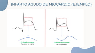 EXAMENES COMPLEMENTARIOS
Electrocardiograma (ECG): Esta primera prueba para diagnosticar un ataque cardíaco
registra las s...