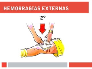 HEMORRAGIAS EXTERNAS
2º
 