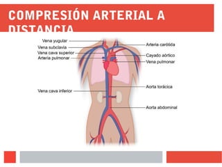 COMPRESIÓN ARTERIAL A
DISTANCIA
 
