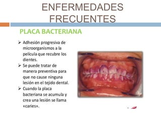 ENFERMEDADES 
FRECUENTES 
PLACA BACTERIANA 
 
