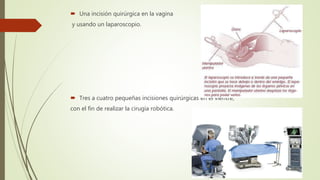  Una incisión quirúrgica en la vagina
y usando un laparoscopio.
 Tres a cuatro pequeñas incisiones quirúrgicas en el vientre,
con el fin de realizar la cirugía robótica.
 