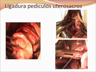 Ligadura pediculos uterosacros 