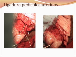 Ligadura pedículos uterinos 