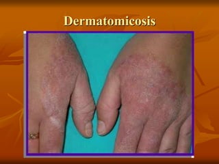 Dermatomicosis
 