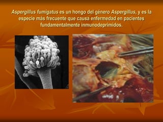 Aspergillus fumigatus es un hongo del género Aspergillus, y es la
especie más frecuente que causa enfermedad en pacientes
fundamentalmente inmunodeprimidos.
 
