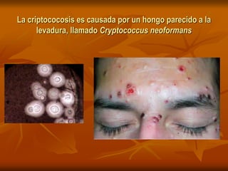 La criptococosis es causada por un hongo parecido a la
levadura, llamado Cryptococcus neoformans
 