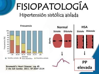 Hipertensión sistólica aislada

             Frecuencia
                                                   Normal                HSA
                                                Sístole   Diástole   Sístole Diástole




                                        Aorta




                                                                        PP
Braunwald's Heart Disease: cap 45
J Am Coll Cardiol, 2011; 57:2037-2114                                elevada
 