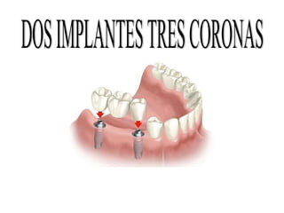 Presentacion implantes