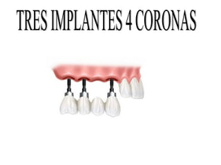 Presentacion implantes