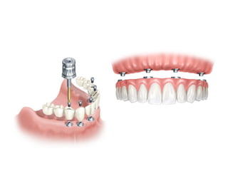 Presentacion implantes