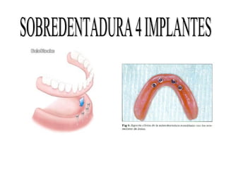 Presentacion implantes
