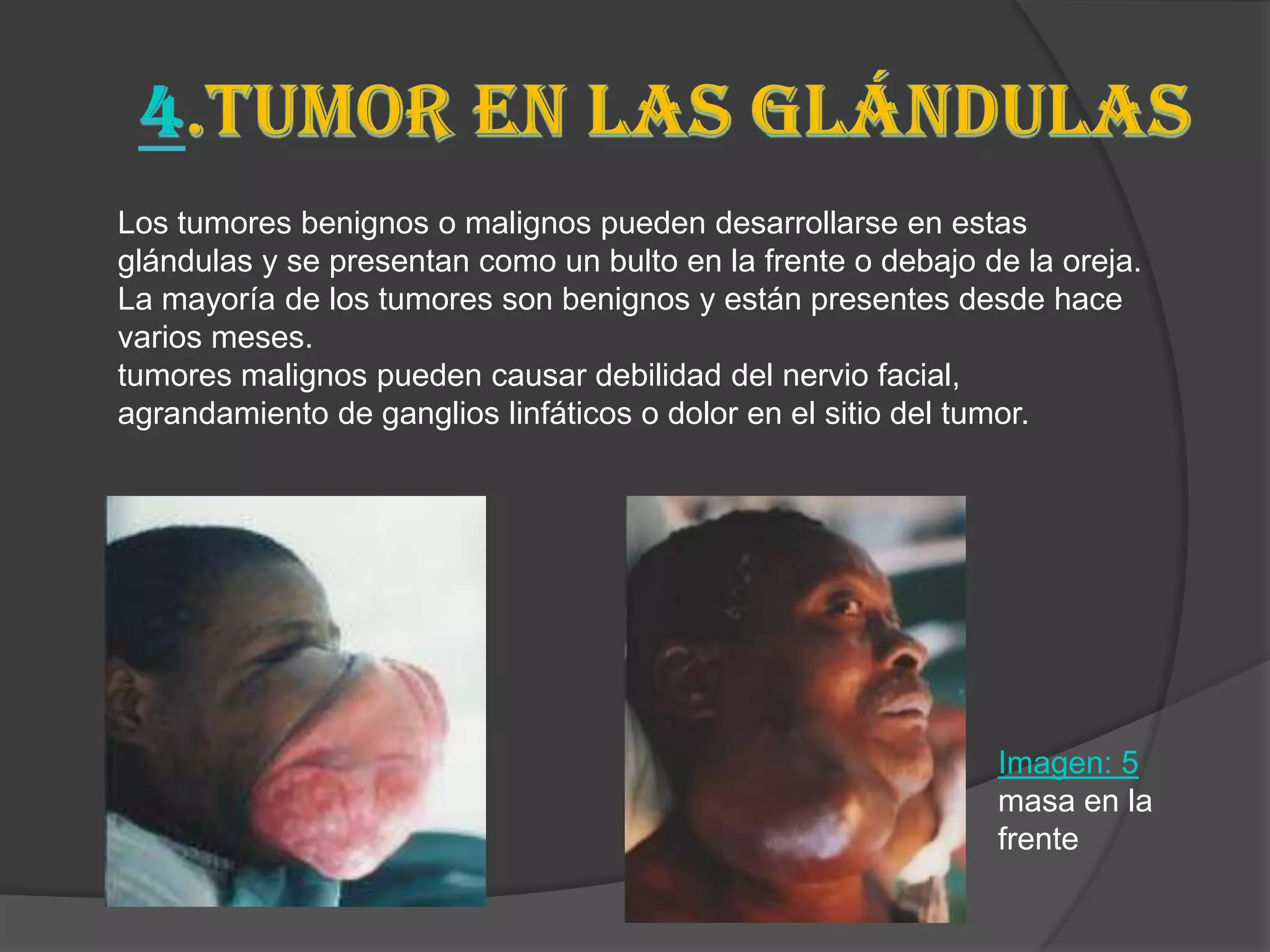 Los tumores benignos o malignos pueden desarrollarse en estas
glándulas y se presentan como un bulto en la frente o debajo de la oreja.
La mayoría de los tumores son benignos y están presentes desde hace
varios meses.
tumores malignos pueden causar debilidad del nervio facial,
agrandamiento de ganglios linfáticos o dolor en el sitio del tumor.




                                                              Imagen: 5
                                                              masa en la
                                                              frente
 