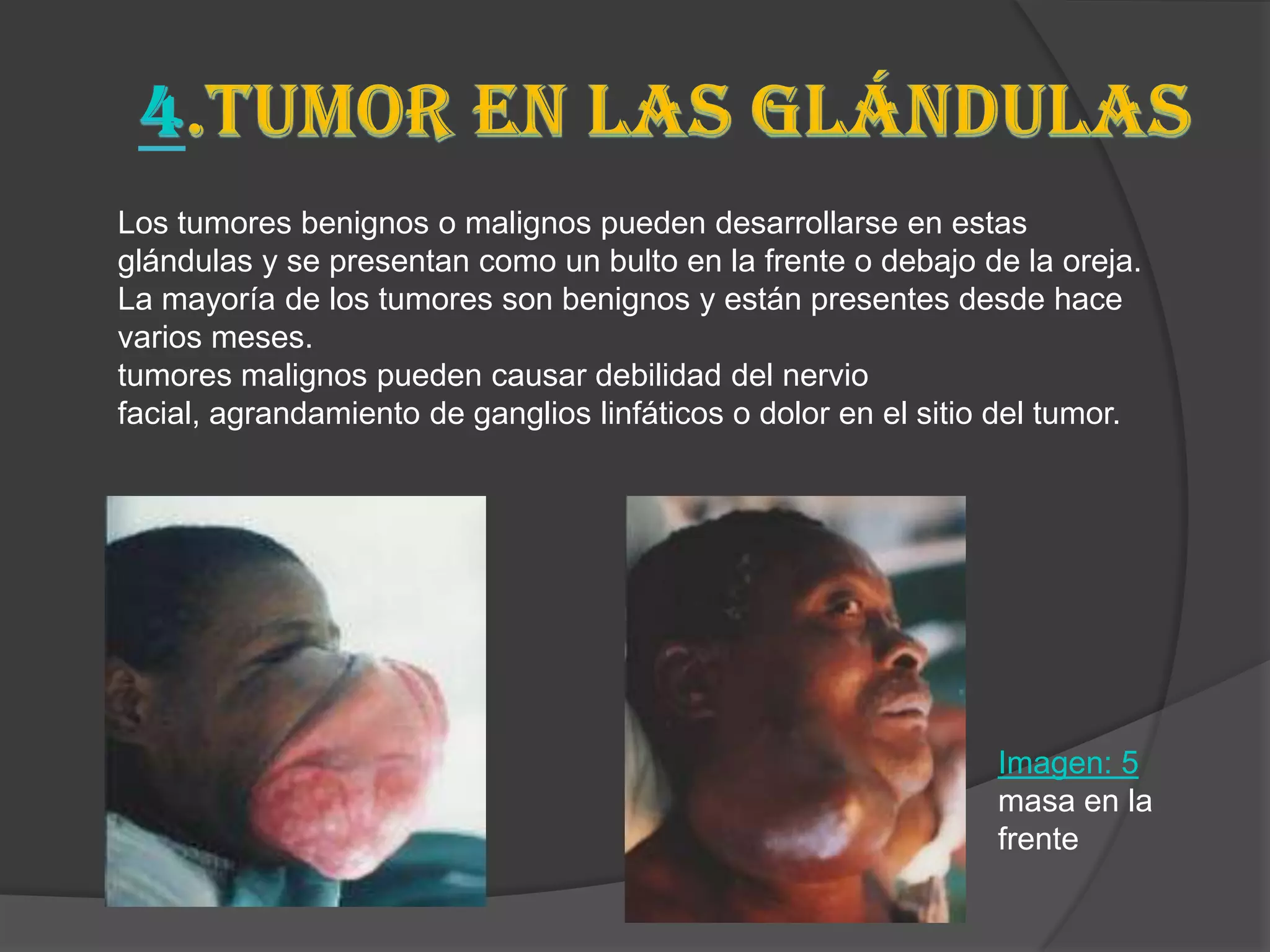Los tumores benignos o malignos pueden desarrollarse en estas
glándulas y se presentan como un bulto en la frente o debajo de la oreja.
La mayoría de los tumores son benignos y están presentes desde hace
varios meses.
tumores malignos pueden causar debilidad del nervio
facial, agrandamiento de ganglios linfáticos o dolor en el sitio del tumor.




                                                                Imagen: 5
                                                                masa en la
                                                                frente
 