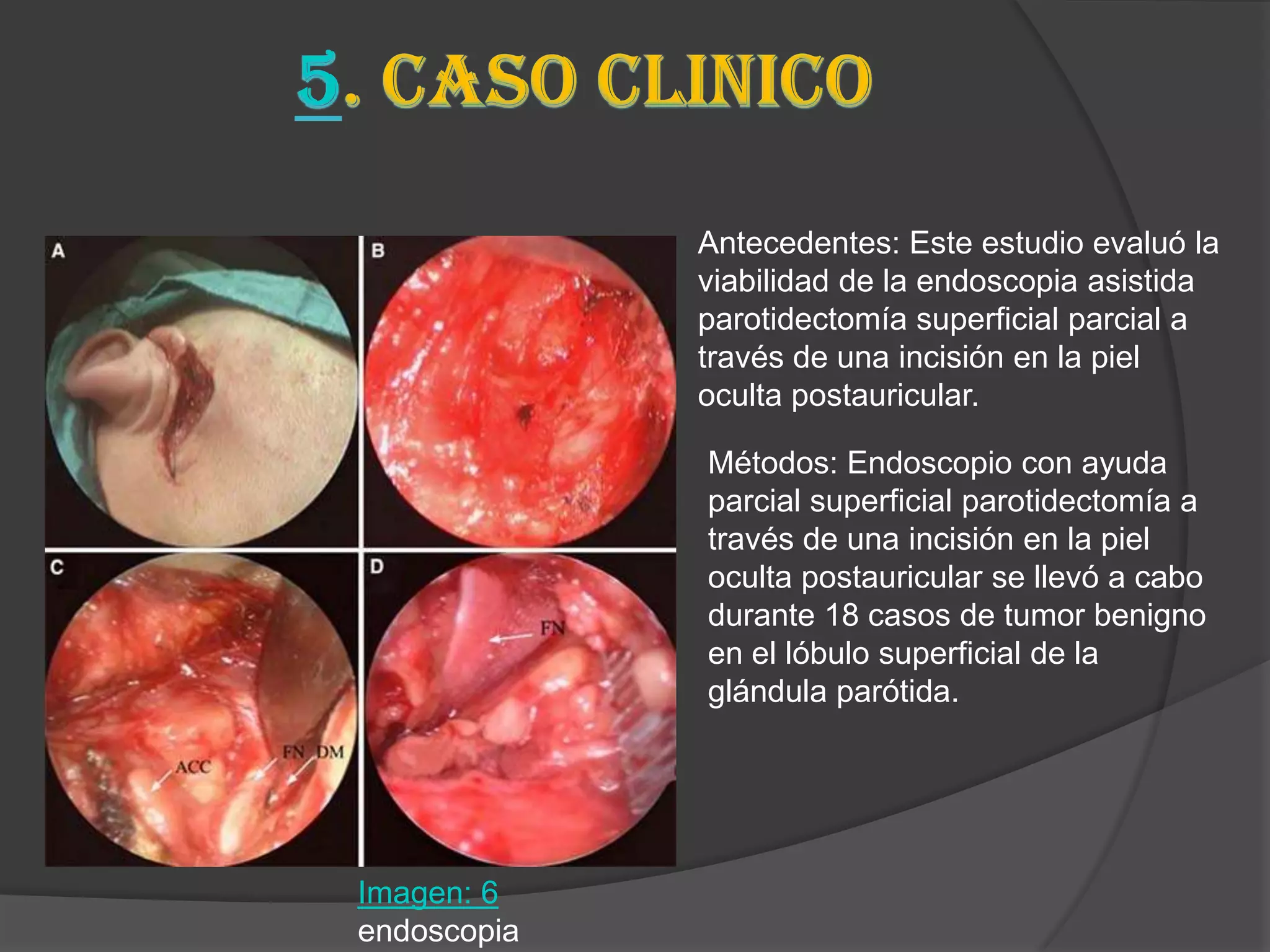 Antecedentes: Este estudio evaluó la
             viabilidad de la endoscopia asistida
             parotidectomía superficial parcial a
             través de una incisión en la piel
             oculta postauricular.

             Métodos: Endoscopio con ayuda
             parcial superficial parotidectomía a
             través de una incisión en la piel
             oculta postauricular se llevó a cabo
             durante 18 casos de tumor benigno
             en el lóbulo superficial de la
             glándula parótida.




Imagen: 6
endoscopia
 