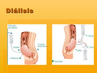 Diálisis 