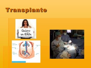 Transplante 