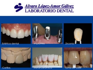 Estética dental   Implantes        Zirconio




Carillas          Metal-cerámica   Toma de color
 