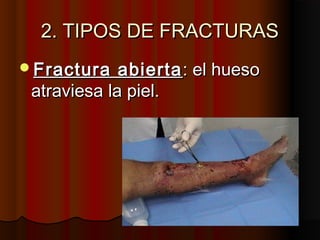 2. TIPOS DE FRACTURAS2. TIPOS DE FRACTURAS
Fractura abiertaFractura abierta: el hueso: el hueso
atraviesa la piel.atraviesa la piel.
 